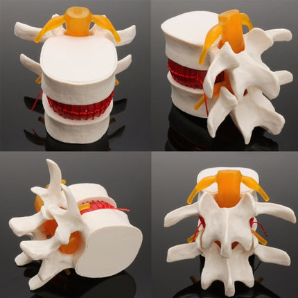Human Lumbar Disc Herniation Demonstration Model Orthopedic Spine Model(Yellow)-garmade.com