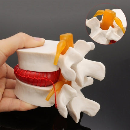 Human Lumbar Disc Herniation Demonstration Model Orthopedic Spine Model(Yellow)-garmade.com